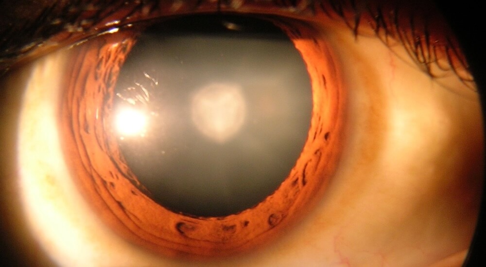 Durch den grauen Star wird die Linse trübe, so dass die Lichtstrahlen gestreut werden