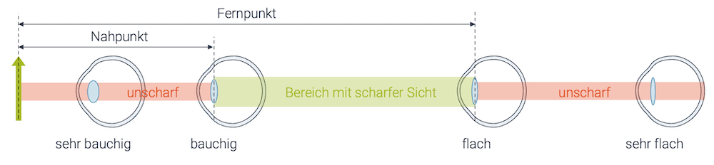 Die Kurzsichtigkeit und Altersweitsichtigkeit kann gleichzeitig auftreten, so dass zwei Sehkorrekturen benötigt werden