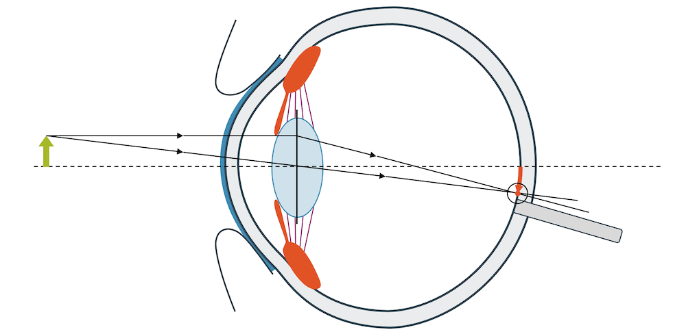 Auge (normale Sicht)