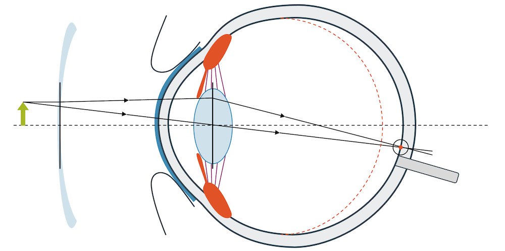 Kurzsichtigkeit Korrektur mit Brille