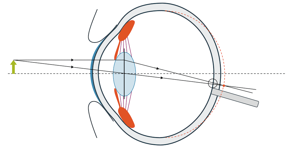 Weitsichtigkeit (ohne Korrektur)