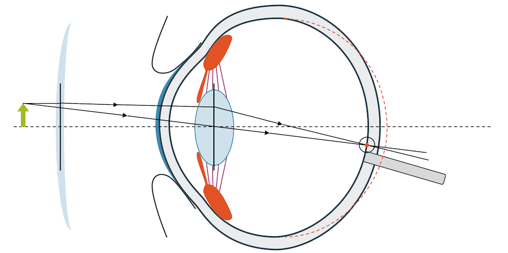 Weitsichtigkeit Korrektur mit Brille